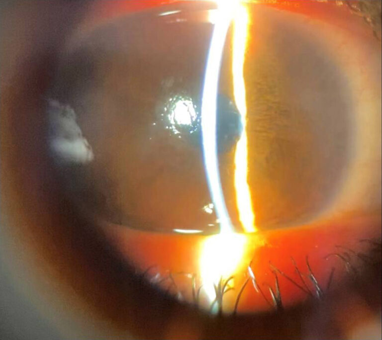 cornea tip 012