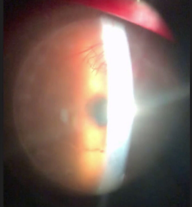 cornea tip 8