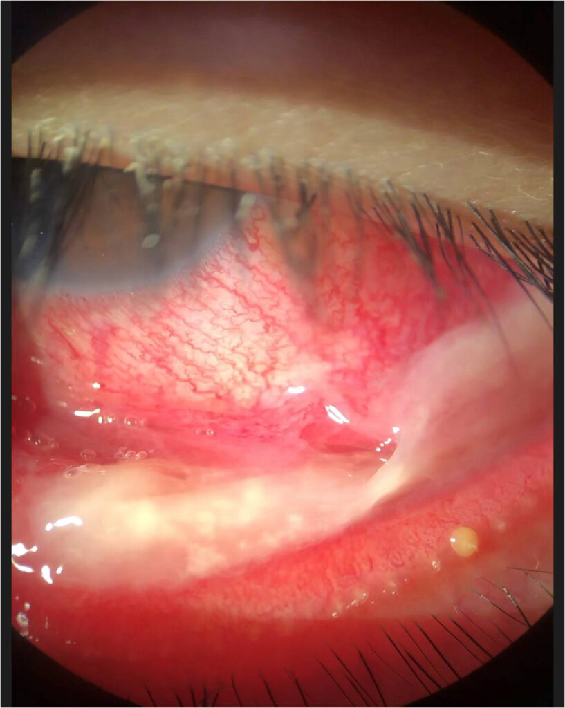 cornea tip 009