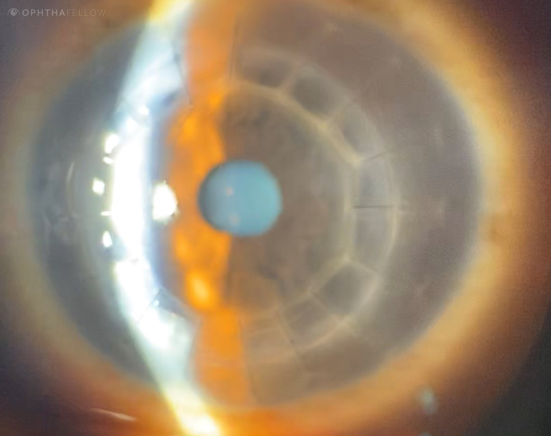 cornea tip 011