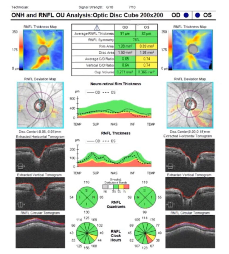 An Unusual Presentation of Glaucoma