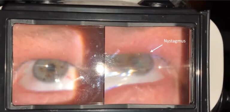 Torsional Nystagmus