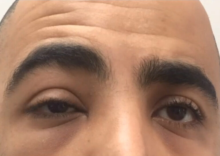 Right Ptosis and Slight Hypotropia