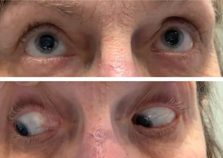 Difficulty Reading and Eye Feels “Off”