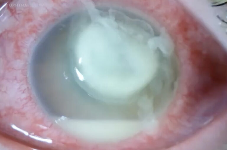 Purulent Discharge on Cornea