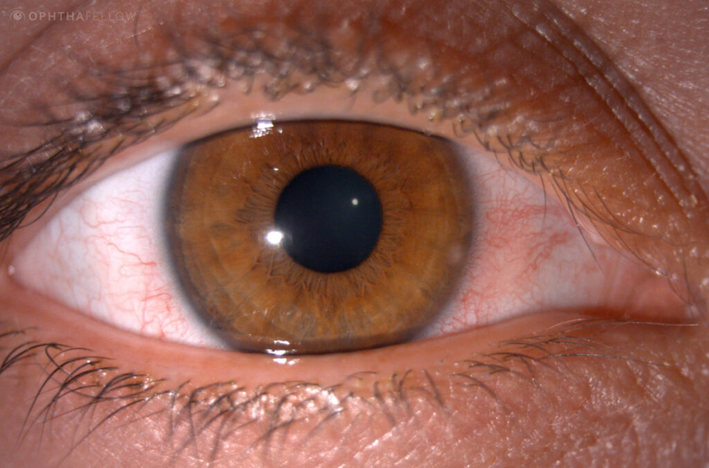 cornea coach 022