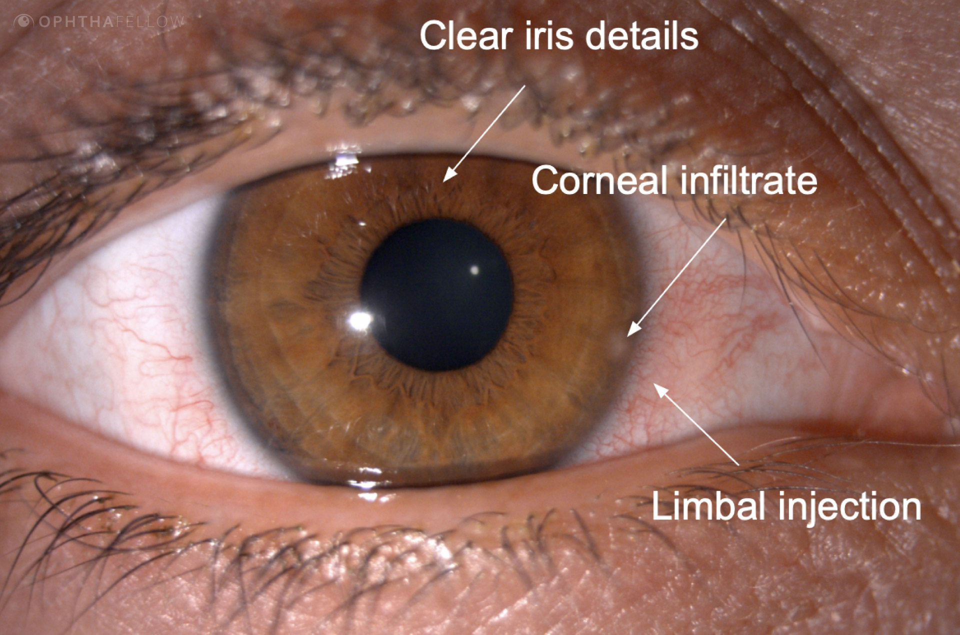 cornea coach 022 analysis