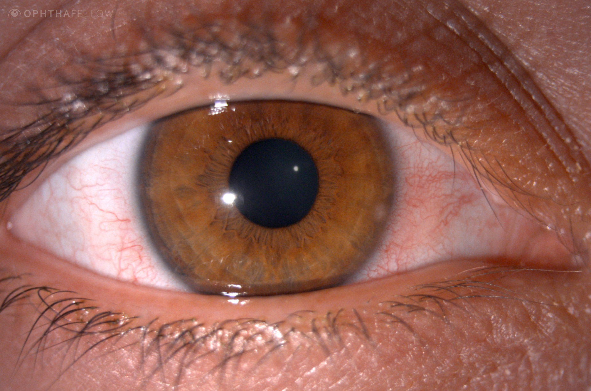 cornea coach 022